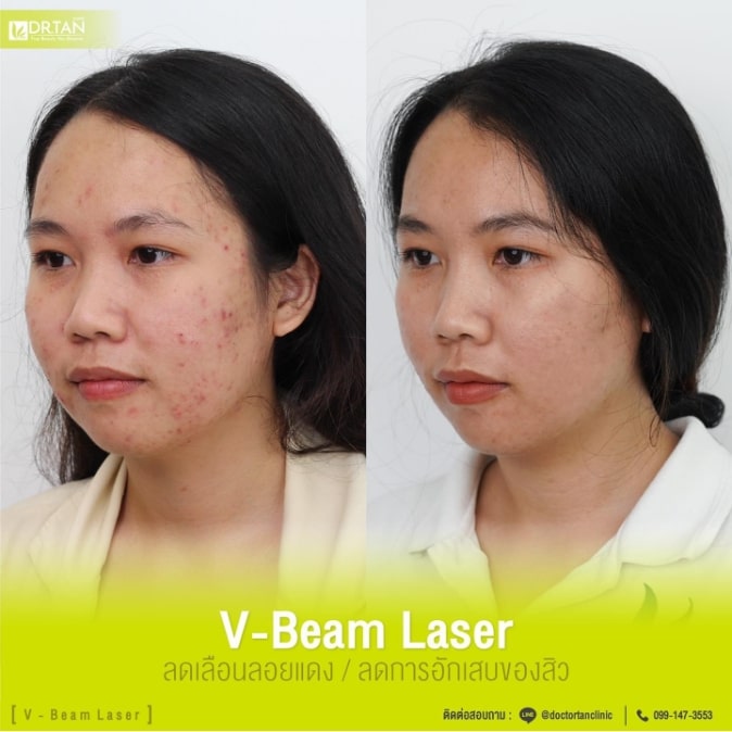 VBeam Laser Dr.Tan Clinic