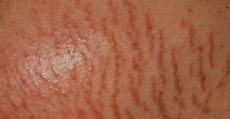Striae-rubra Striae-rubra